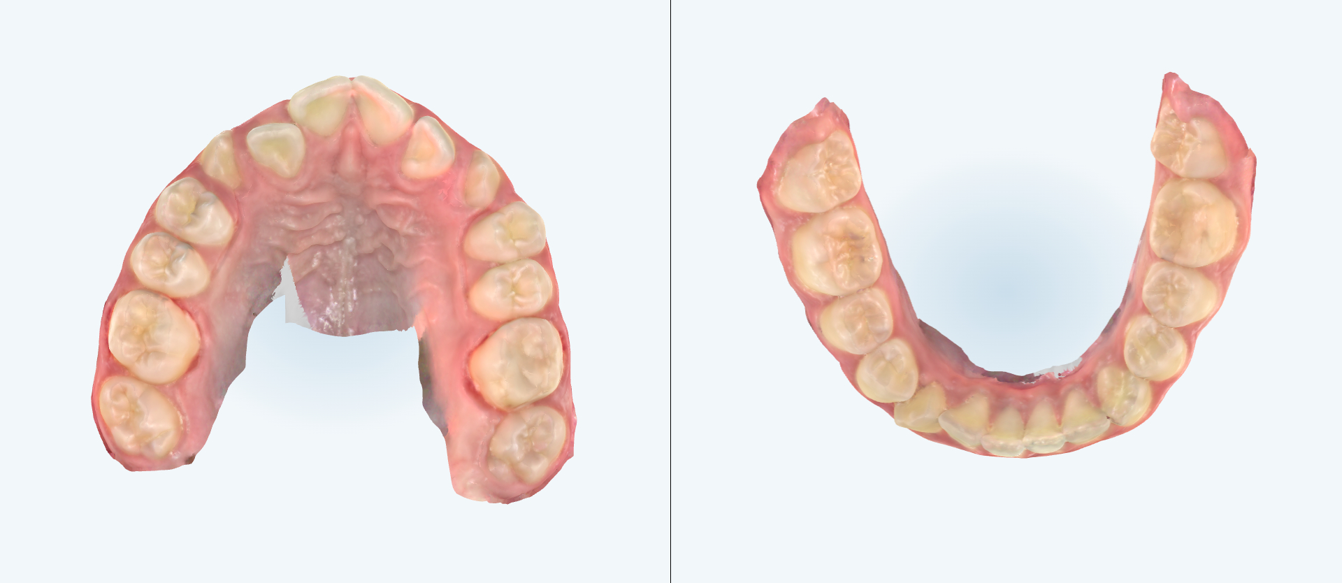 Crowding treatment comparison case 2 before
